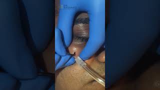 The FASTEST Way to Remove Mole Without Surgery DrLalit Kasanas [upl. by Monagan204]