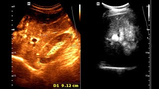 Sonographic Features of Gastric carcinoma  Limitations of Ultrasound  Complementary Imaging [upl. by Alesig41]