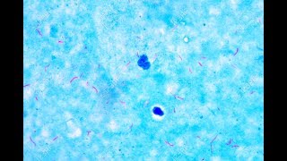 Mycobacterium under microscope afb positive [upl. by Enicar]