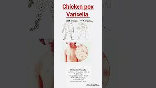 Chicken pox varicella  viralshorts chickenpox varicella [upl. by Gross886]