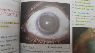 Keratoplasty  EYE [upl. by Elsbeth]