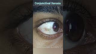 Xerophthalmia  Conjunctival Xerosis  Vitamin A Deficiencies [upl. by Herzen]