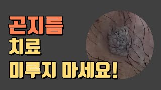 곤지름condyloma 콘딜로마  성기사마귀 치료 미루지 마세요 [upl. by Lebatsirhc510]