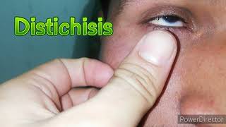 Distichiasis lower eyelid [upl. by Eugenio]