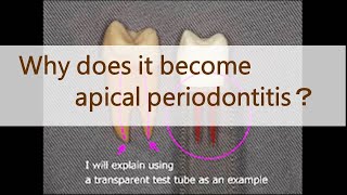 Why does it become apical periodontitis？ [upl. by Obaza]