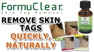 FORMUCLEAR SKIN TAG REMOVER [upl. by Craig]