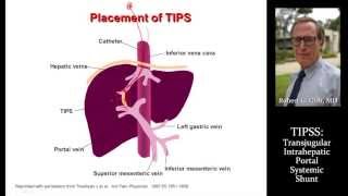 TIPSS by Dr Robert Gish [upl. by Ecinev]