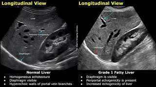 Fatty Liver Grading On Ultrasound  USG Normal Vs Abnormal Images  Grades 12 amp 3 Hepatic Steatosis [upl. by Kalina593]