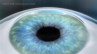 3rd Generation SMILE Laser Eye Surgery  Revolutionary bladeless procedure [upl. by Marthe]