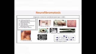 Neurofibromatosis mrcpch Clinical [upl. by Shelburne]