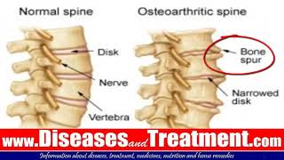 3 Osteophytes Bone Spur Causes Symptoms Diagnosis Treatment [upl. by Dulci]