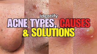 How to Tackle Different Acne Types Causes amp Solutions for Clear Skin 🍀 [upl. by Amoakuh]