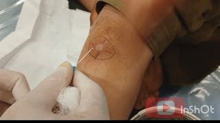 abscess Drainage near to joint ❤️ تخلیه آبسی نیزدیک مفصل زانوviral explore subscribe tiktok [upl. by Dianne]