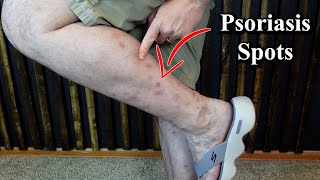 My Psoriasis is Getting Better  Update and More [upl. by Eneluqcaj339]