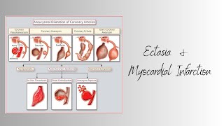 Myocardial Infarction in Ectatic Coronaries indiancathtechs [upl. by Evalyn90]