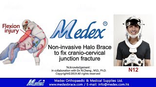 N12  Noninvasive Halo Brace to fix craniocervical junction fracture 3D Animation [upl. by Macpherson]