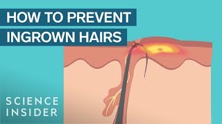 What Are Ingrown Hairs — And How To Treat Them [upl. by Behre260]