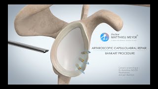 ARTHROSCOPIC SHOULDER STABILISATION BANKART PROCEDURE  DR MATTHIEU MEYER  PARIS FRANCE [upl. by Otineb]