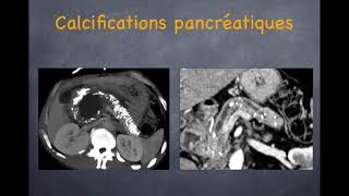 Pancréatite chronique  1 Diagnostic positif [upl. by Lemej429]