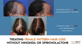 How Female Pattern Hair Loss can be Treated Without Minoxidil or Spironolactone [upl. by Ieluuk274]