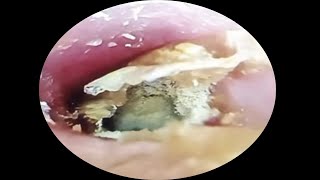 Fungous dry orange earwax extraction asmrearwax 20 [upl. by Radu]