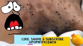 GREATEST ACNE EXTRACTION PART9🎵🤓 WHITEHEADBLACKHEAD EXPLOSION 2020 popmyfacenow acneextraction [upl. by Rhu173]