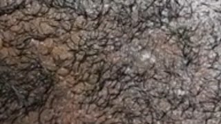 satisfying infected ingrown hair removal viral asmr ingrownhair trending [upl. by Fabi64]