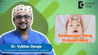 Endoscopic Strip Craniectomy amp Helmet Therapy craniosynostosis  Dr Vybhav Deraje Doctors Circle [upl. by Collins]