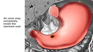 How Stomach Ulcers Form Animation  Peptic Ulcer Disease Causes Symptoms and Treatments Video [upl. by Sachsse802]