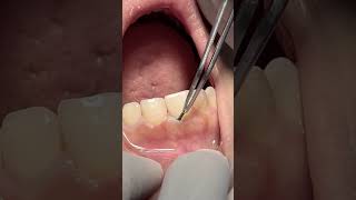 Retraction cord dentist satisfying [upl. by Binetta220]