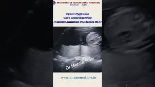 Cystic hygromaFetal ultrasound ultrasound drrandhawainstitute obgyn medicalvideos [upl. by Valry]