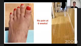 MIS Bunion Correction [upl. by Manolo309]