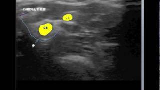 C5C6 cervical nerve root blocks [upl. by Eduino]