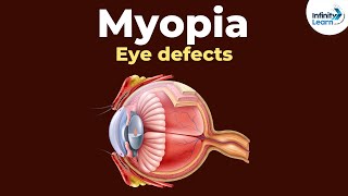 Eye defects  Myopia  Dont Memorise [upl. by Grefe41]