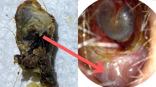 150  Huge Ear Wax Plug Extracted from Ear Crater due to Benign Osteonecrosis using WAXscope®️ [upl. by Canute]