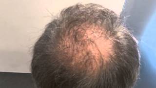 Scalp Micro pigmentation result prohairclinic [upl. by Ansel]