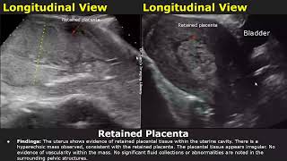 Postpartum Uterus Ultrasound Reporting  RPOCRetained Placenta Scan Reports  Pelvic USG [upl. by Bega]