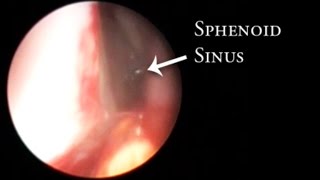 Inoffice balloon dilation of the sphenoid sinus [upl. by Carny]