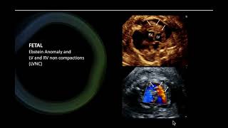 Fetal Ebstein noncompaction [upl. by Alcine530]