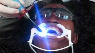 6 HOW TO PUT BRACES ON  GETTING BRACES INSTALL  PUTTING BRACES ON 1215th2010 [upl. by Morrill]