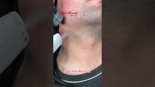 Laser Hair Removal getsmarthairclub viralvideo hairremoval [upl. by Mayor]