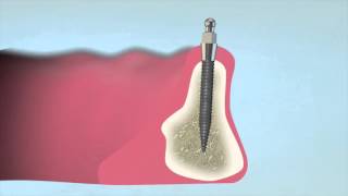 How to Place a 3M™ ESPE™ MDI Mini Dental Implant [upl. by Hildegarde]