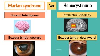 Marfan Syndrome Vs Homocystinuria Mnemonics And High Yield Points For For NEET PG  FMGE [upl. by Pelagi994]