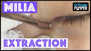 Milium Extraction from a Very Delicate Inner Eye Area [upl. by Marjie]