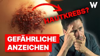 5 Anzeichen für Hautkrebs Selbst die Gefahr erkennen  ABCDERegel [upl. by Reyna692]