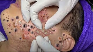 Big Cystic Acne Blackheads Extraction Blackheads amp Milia Whiteheads Removal Pimple Popping  1020 [upl. by Yelnet]