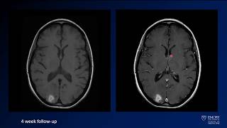 Imaging intracranial hemorrhage  Case 3  PRES  posterior reversible encephalopathy syndrome [upl. by Jallier]