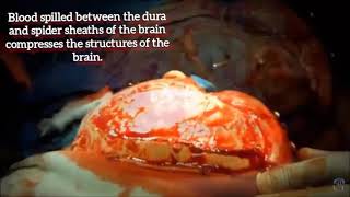 Subdural hematomavideo based mymedmo [upl. by Eirol]