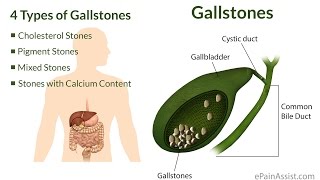 Drinking apple cider to flush out gall bladder stones ENG SUB [upl. by Akirea]