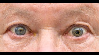 Anisocoria  Symptoms and Causes  Diagnosis  Treatment  Prevention [upl. by Mord]